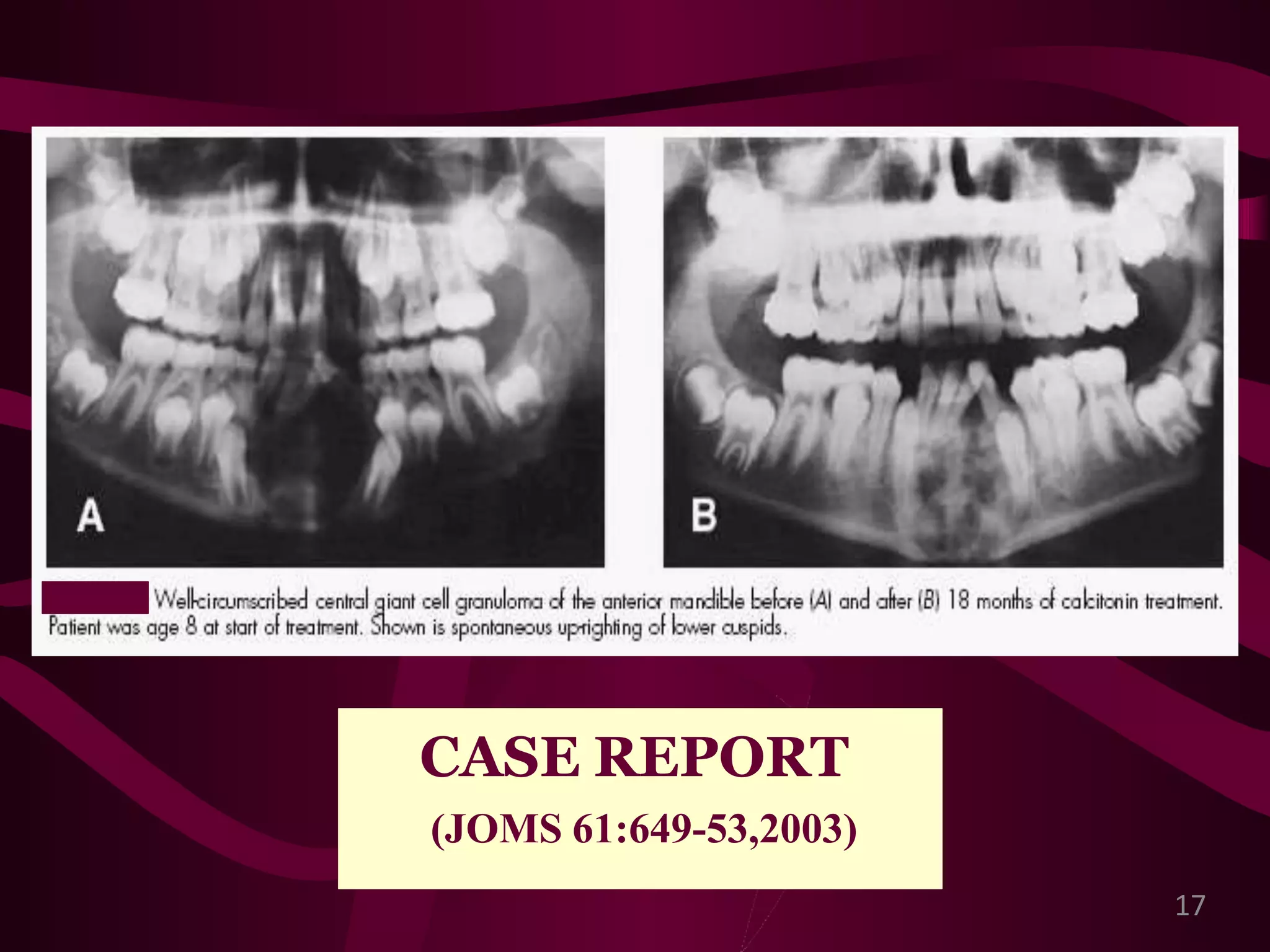 Giant cell lesions of the jaws | PPT