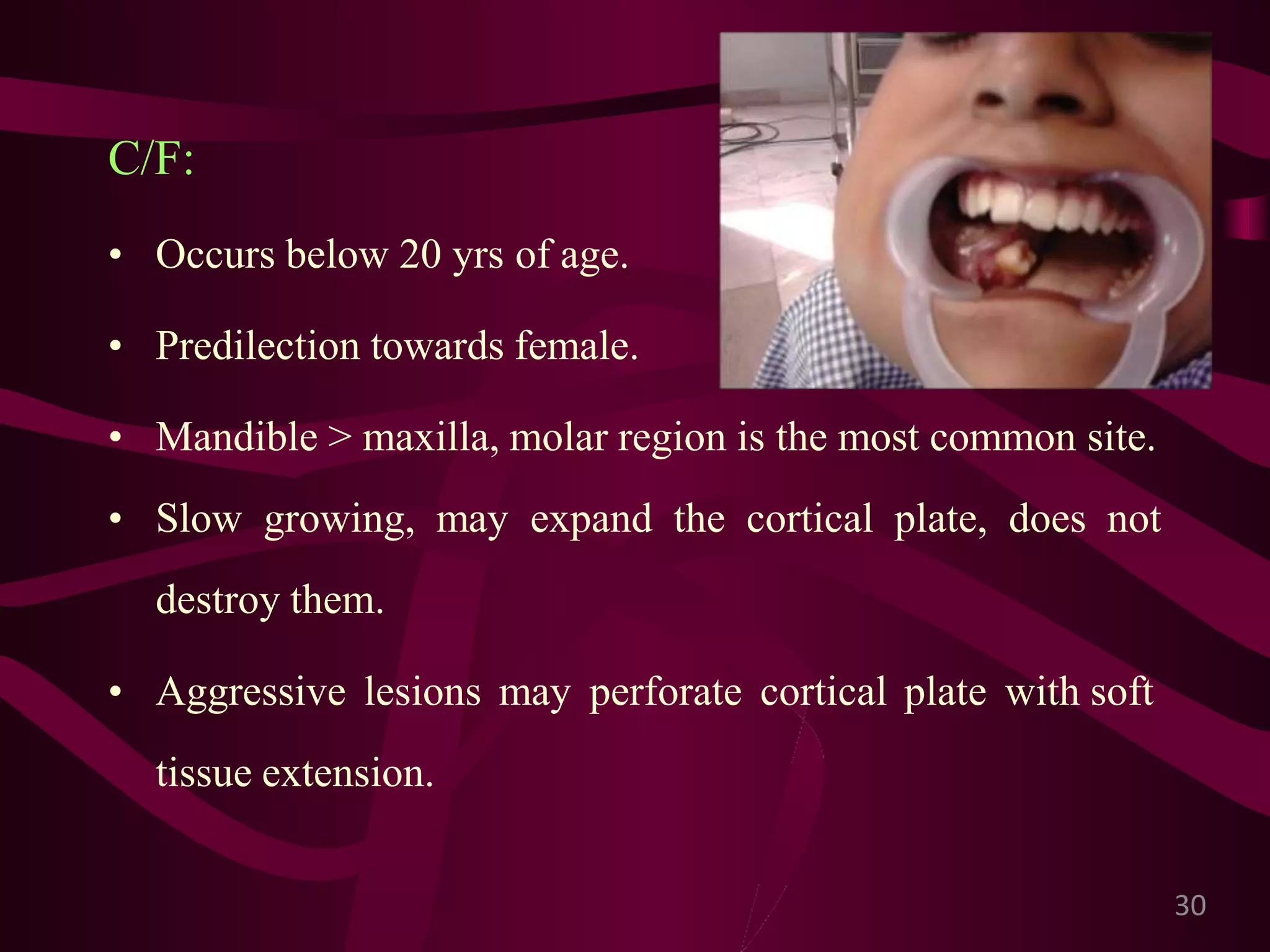 Giant cell lesions of the jaws | PPTX