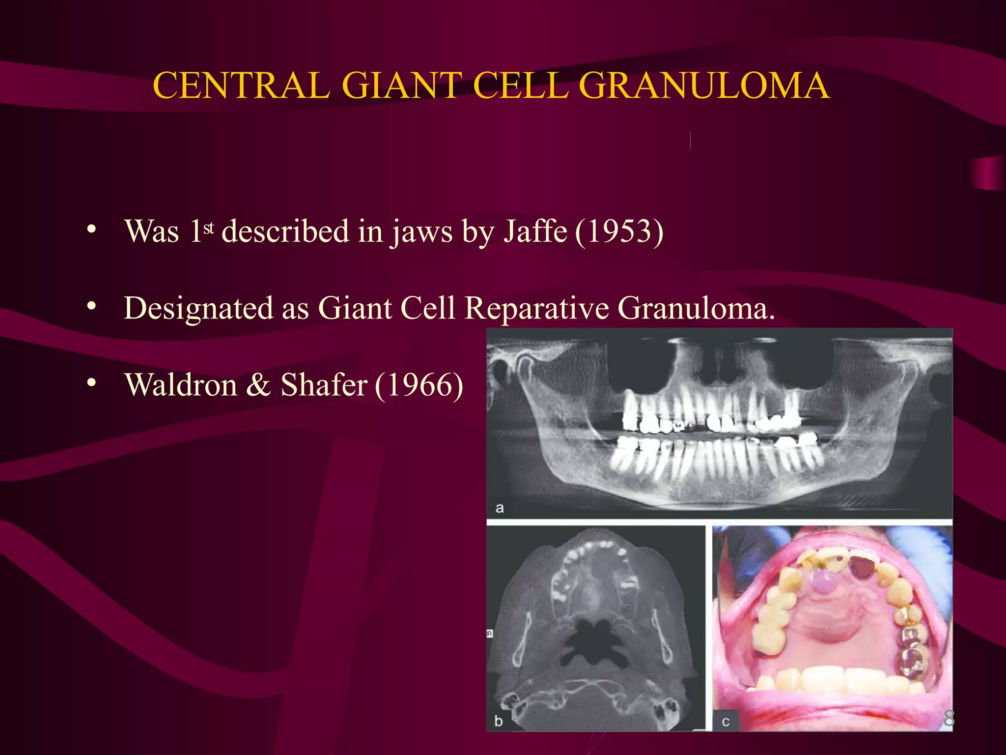 Giant cell lesions of the jaws | PPTX