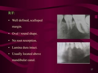Giant cell lesions of the jaws | PPTX