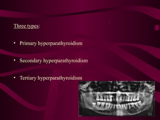 Giant cell lesions of the jaws | PPTX