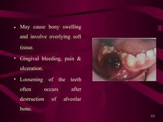 Giant cell lesions of the jaws | PPTX