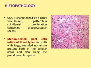 Flooret Cells GIANT CELL LESIONS.pptx