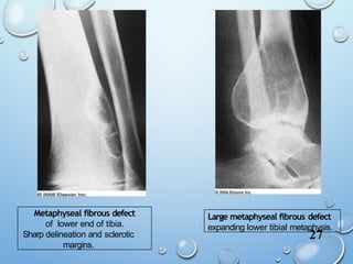 giant cell lesions in bone - Shilpa Gupta.pptx