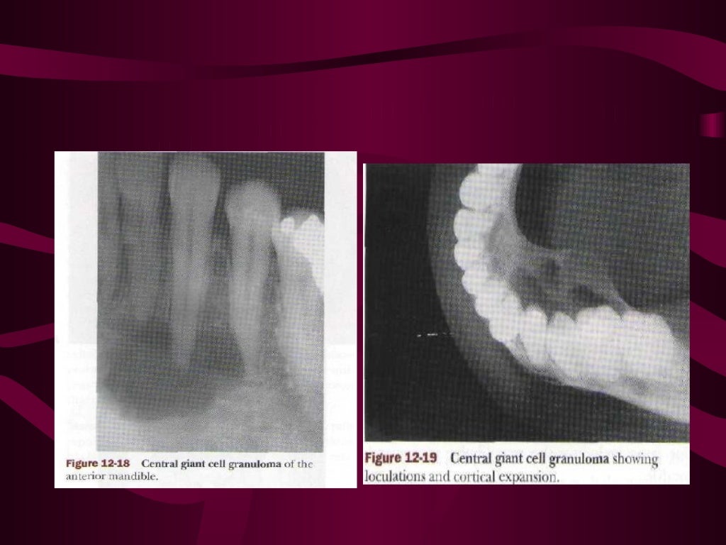 Giant cell lesion’s of jaw