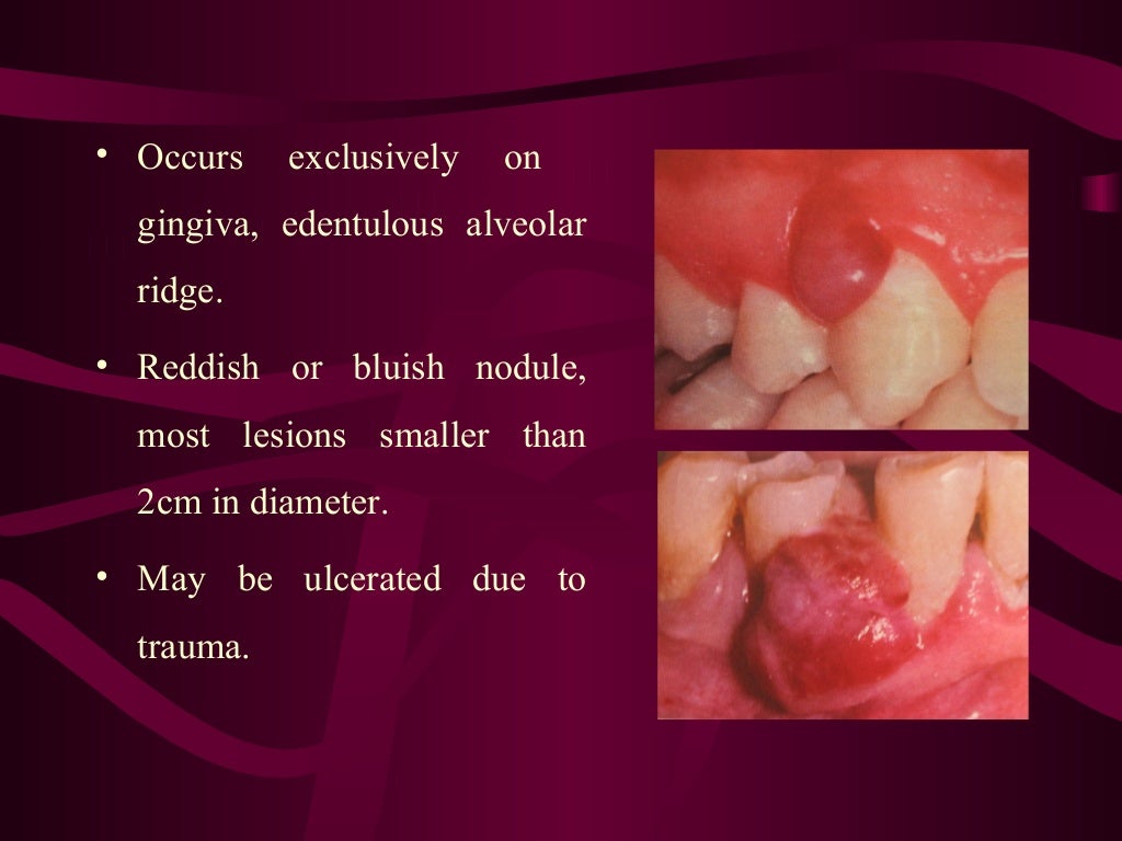Giant cell lesion’s of jaw