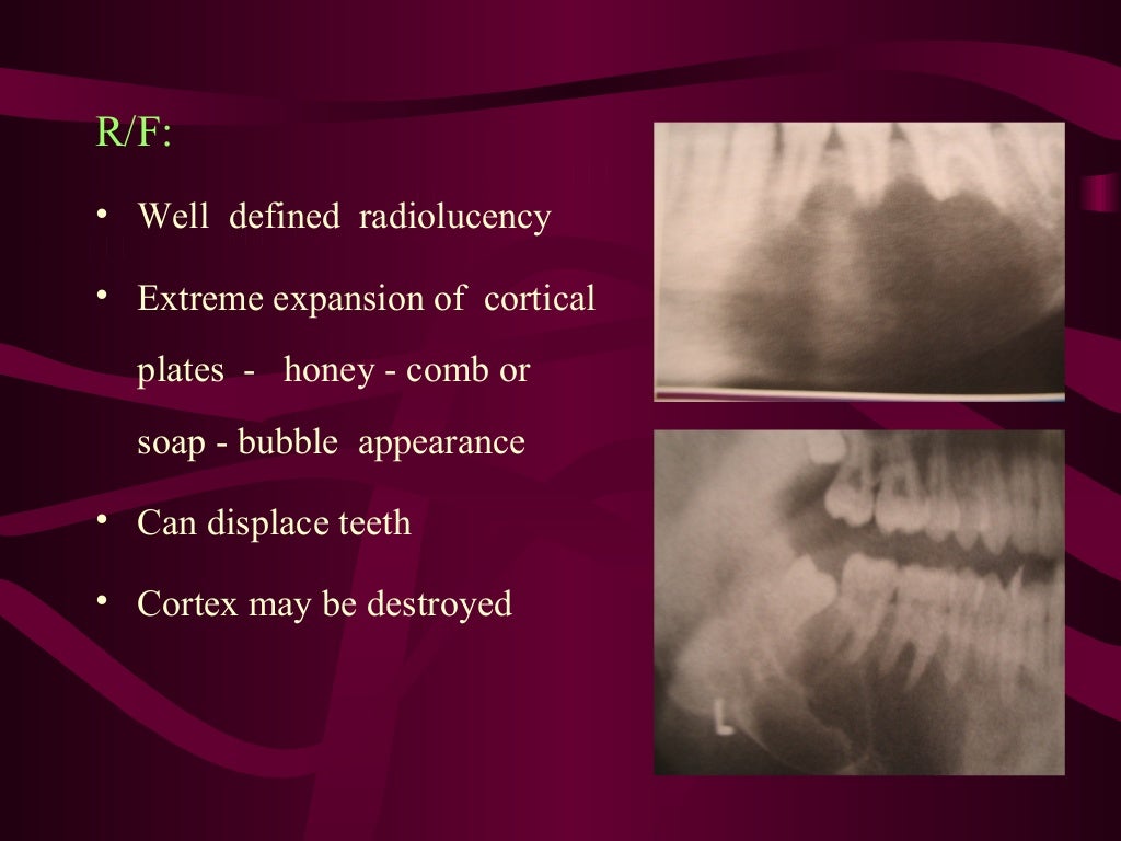Giant cell lesion’s of jaw