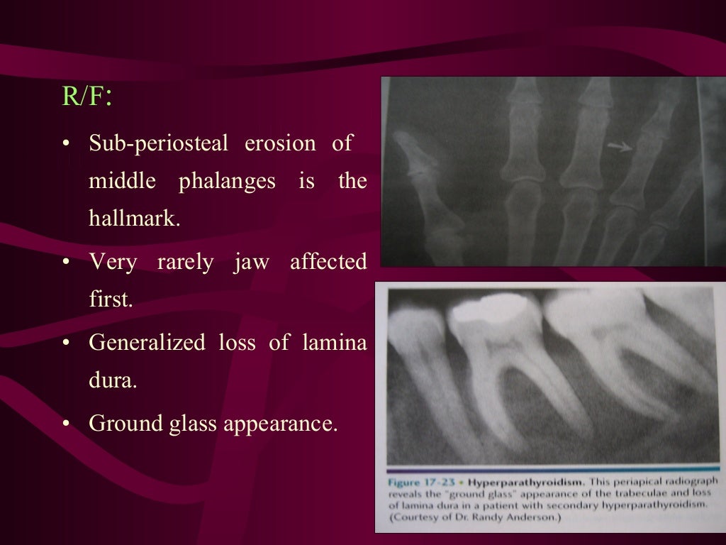 Giant cell lesion’s of jaw