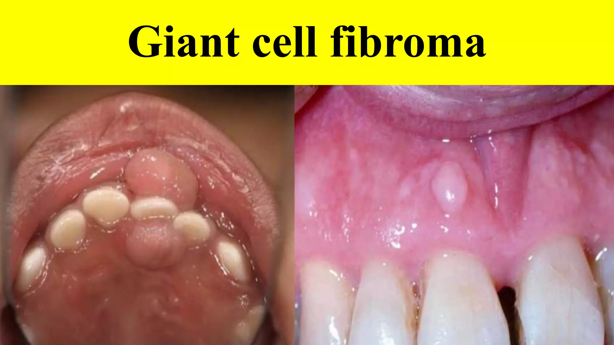Giant cell lesions of oral cavity | PPTX