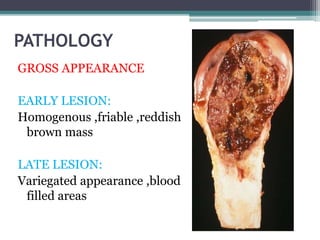 PATHOLOGY 
GROSS APPEARANCE 
EARLY LESION: 
Homogenous ,friable ,reddish 
brown mass 
LATE LESION: 
Variegated appearance ,blood 
filled areas 
 
