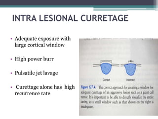 INTRA LESIONAL CURRETAGE 
• Adequate exposure with 
large cortical window 
• High power burr 
• Pulsatile jet lavage 
• Curettage alone has high 
recurrence rate 
 