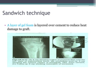 Sandwich technique 
• A layer of gel foam is layered over cement to reduce heat 
damage to graft. 
 