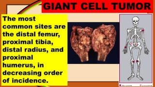 GIANT CELL TUMOR
The most
common sites are
the distal femur,
proximal tibia,
distal radius, and
proximal
humerus, in
decreasing order
of incidence.
 