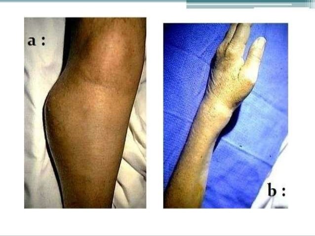 Giant cell tumour And Osteosarcoma