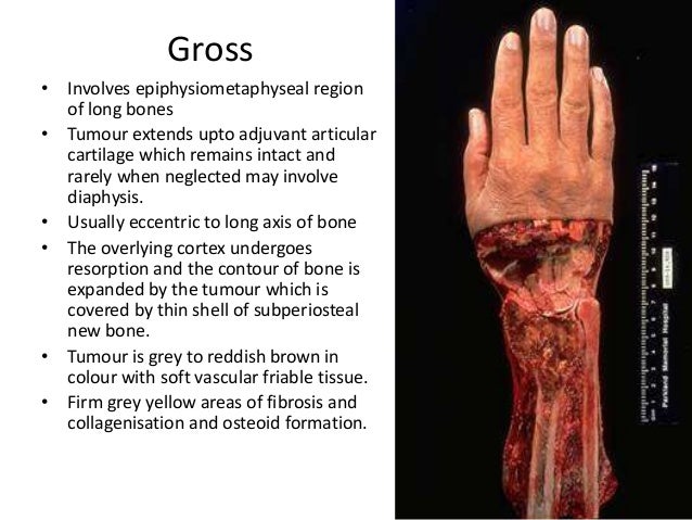 giant cell tumour of bone definition expanded form