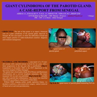 GIANT CYLINDROMA OF THE PAROTID GLAND.
           A CASE-REPORT FROM SENEGAL
                     ABBAS A , ESSALKI I , TALL A , DIOUF R , NDIAYE IC , DIOP EM
                                  1                  2            2             2              2             2
                                      1
                                          ENT Resident of Marseille – CHU Timone - (France)   aliabbas07@yahoo.fr       2
                                                                                                                            Clinique
                                                 ORL – CHU A. Le Dantec – Dakar (Senegal)




• OBJECTIVE: The aim of this poster is to report a historical
 case of a giant cylindroma of the parotid gland, observed in
 Senegal. By this case-report, we show the difficulties of head and
 neck surgery practice in under-medicalized countries: diagnosis
 and treatment management.




                                                                      Fig 1: giant tumor of           Fig 2: ulcerative and
                                                                      parotid gland                   polylobed aspect




• MATERIAL AND METHODS: a case-report of a 27-year-
 old woman with a parotid tumour evolved for ten years, with a
 faster progression in the last year after a scarification (Fig 1),
 hospitalized in November 2004 in the ENT department of the
 university hospital of Dakar (Senegal).
  The patient had a facial palsy (Stade III of House and Brackmann
 classification) and a cervical lymphatic metastasis. The tumor
 measured 9x8 cm and was polylobed (Fig 2, 3a & 3b), sensible
 and with a parotid duct inflammatory. The tumour was classified
 T4bN1MX (according to classification TNM 2002).
   Without RMN imaging neither needle aspiration biopsy, we
 decided to perform a non-conservative surgery: radical (removal      Fig 3a & 3b: giant tumor of parotid gland measuring 9x8 cm
 of facial nerve) and total parotidectomy.
 