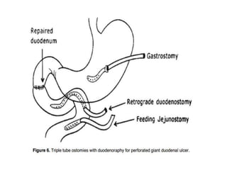 Giant Duodenal perforation Management.pptx