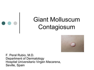 Giant Molluscum
Contagiosum
F. Peral Rubio, M.D.
Department of Dermatology
Hospital Universitario Virgen Macarena,
Seville, Spain
 