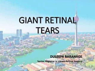 GIANT RETINAL
TEARS
DULEEPA BARANAGE
Senior Registrar in Vitreo-Retinal Surgery
 