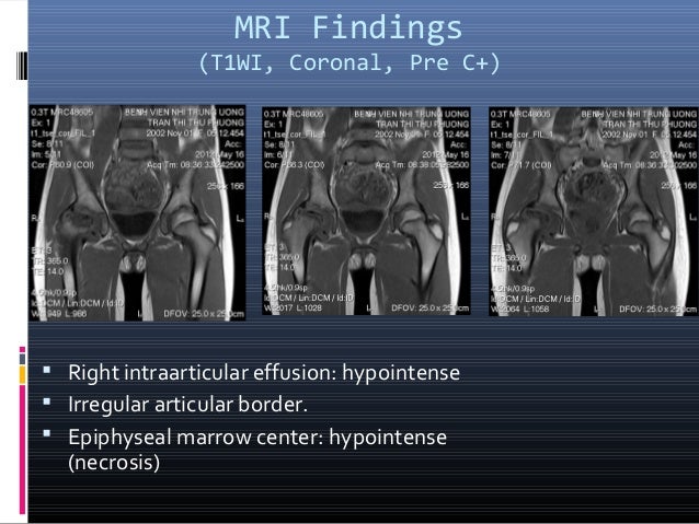 mri of knee