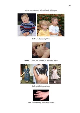 Một số hậu quả do đột biến nhiễm sắc thể ở người 
4 
Hình 6.16. Hội chứng Down 
Hình 6.17. Hình ảnh "rãnh khỉ" ở hội chứng Down 
Hình 6.18. Hội chứng turner 
Hình 6.19. Dị tật tay ở hội chứng Turner 
115 
 