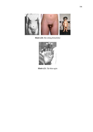 Hình 6.20. Hội chứng Klinefelter 
Hình 6.21. Tật thừa ngón 
116 
 