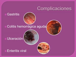 Gastritis
Colitis hemorrágica aguda
Ulceración
Enteritis viral
 