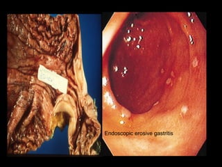 Endoscopic erosive gastritis
 