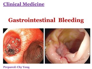 Gastrointestinal Bleeding
Clinical Medicine
Prepared: Chy Yong
 