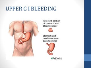 UPPER G I BLEEDING
 