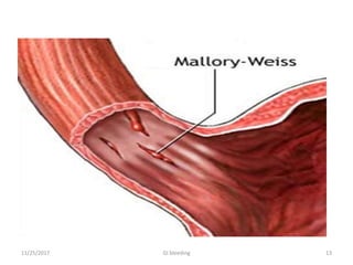 11/25/2017 13GI bleeding
 