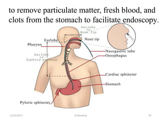 GI bleeding 47
to remove particulate matter, fresh blood, and
clots from the stomach to facilitate endoscopy.
11/25/2017
 
