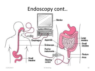 Endoscopy cont..
11/25/2017 GI bleeding 50
 