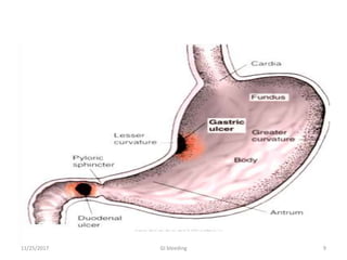 11/25/2017 9GI bleeding
 