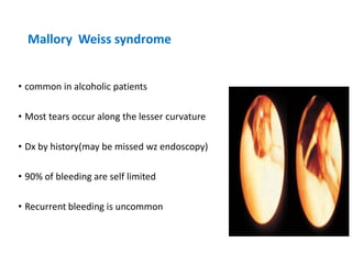 Mallory Weiss syndrome
• common in alcoholic patients
• Most tears occur along the lesser curvature
• Dx by history(may be missed wz endoscopy)
• 90% of bleeding are self limited
• Recurrent bleeding is uncommon
 