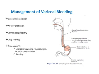 Management of Variceal Bleeding
❖General Resuscitation
❖Air way protection
❖Correct coagulopathy
❖Drug Therapy
❖Endoscopic Tx
✓ sclerotherapy using ethanolamine oleate
or butyl cyanoacrylate
✓ Banding
 