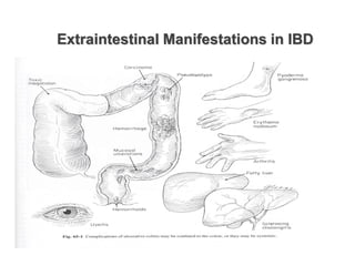 Extraintestinal Manifestations in IBD
 
