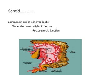 Cont’d…………..
Commonest site of ischemic colitis
Watershed areas –Splenic flexure
-Rectosegmoid junction
 