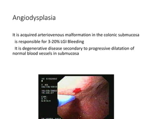 Angiodysplasia
It is acquired arteriovenous malformation in the colonic submucosa
is responsible for 3-20% LGI Bleeding
It is degenerative disease secondary to progressive dilatation of
normal blood vessels in submucosa
 