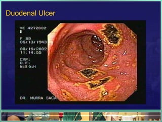 Duodenal Ulcer
 