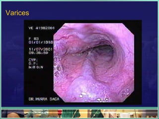 Varices
 