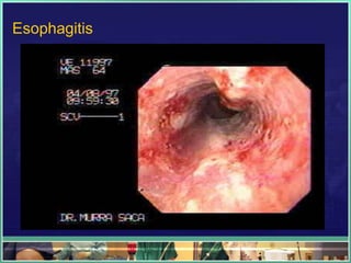 Esophagitis
 