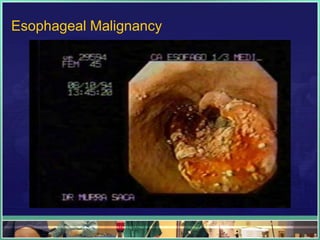 Esophageal Malignancy
 