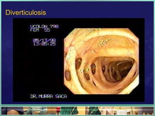 Diverticulosis
 