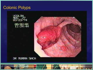 Colonic Polyps
 