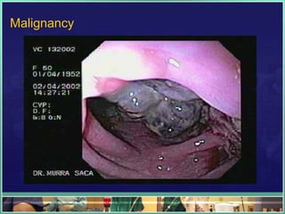Malignancy
 