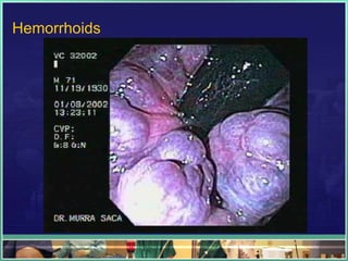 Hemorrhoids
 