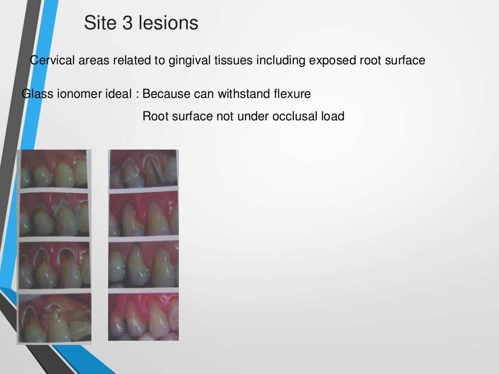 Glass ionomer cement