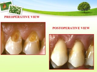PREOPERATIVE VIEW
POSTOPERATIVE VIEW
 