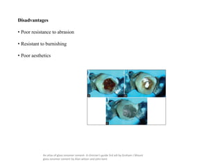 Disadvantages
• Poor resistance to abrasion
• Resistant to burnishing
• Poor aesthetics
An atlas of glass ionomer cement- A clinician's guide 3rd edi by Graham J Mount
glass ionomer cement by Alan wilson and john kent
 